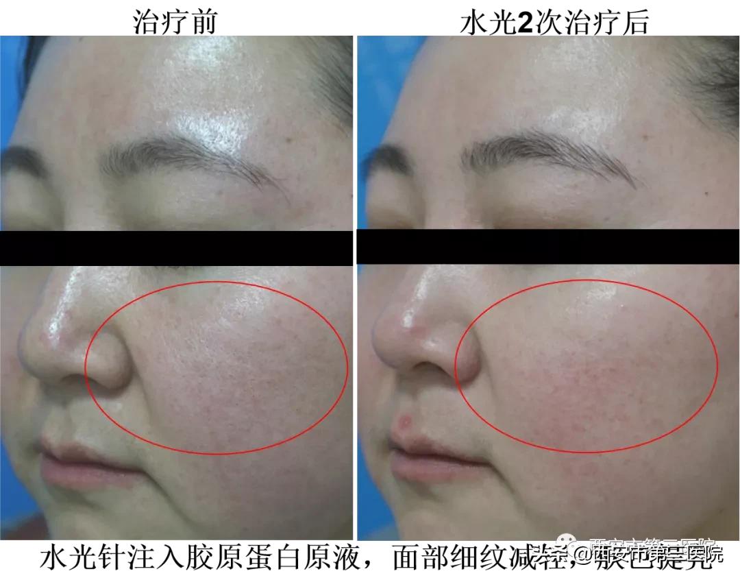 紧致肌肤的微针,淡化细纹微针