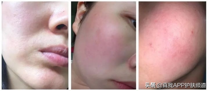 皮肤刷酸到底是什么意思,皮肤刷酸多久一次比较好