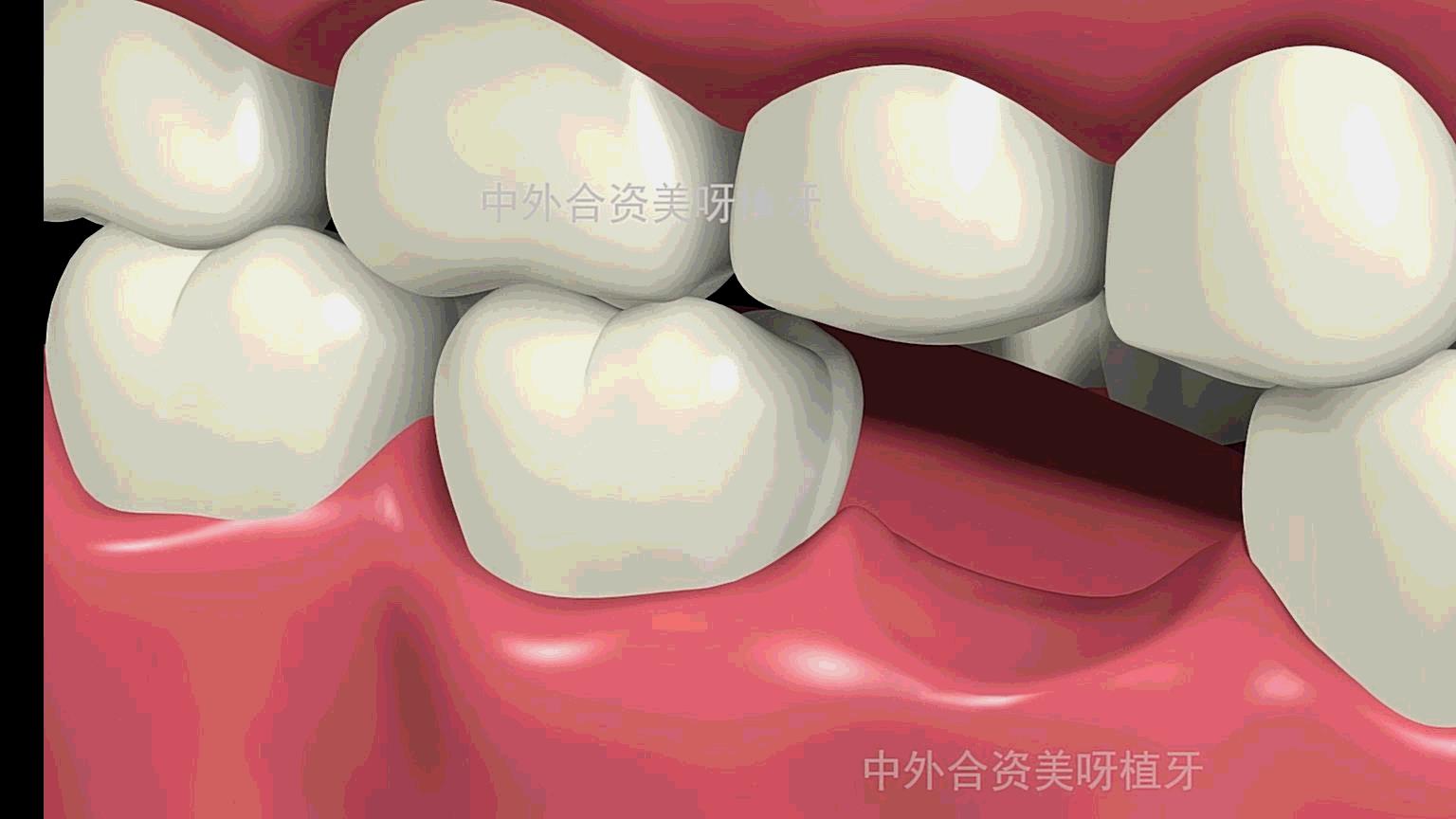 高龄老人适合种植牙吗,老人是否适合种牙