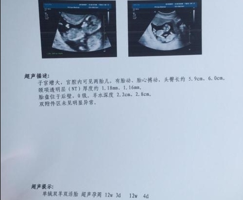 四维超声和二维b超的区别,产检b超比前两次小