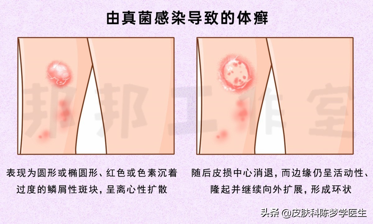 红色斑块脱屑一定是牛皮癣吗,皮肤上有癣起皮颜色呈褐色
