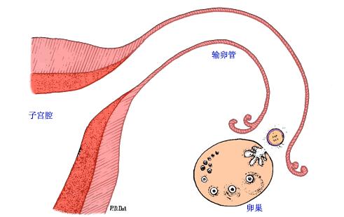 子宫内膜息肉会导致不孕的情况吗,子宫内膜息肉会导致不孕吗
