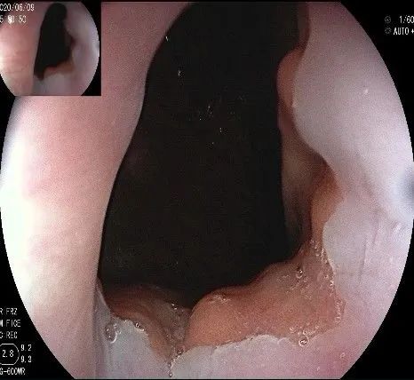 贲门隆起性病变影像,贲门溃疡隆起性病变