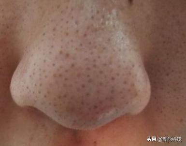 “草莓鼻”克星来了！仅135g，149价格499质量，松下：逼我降价？