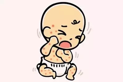 哺乳期什么食物容易引起宝宝湿疹,湿疹绝对不能吃的食物你知道几种