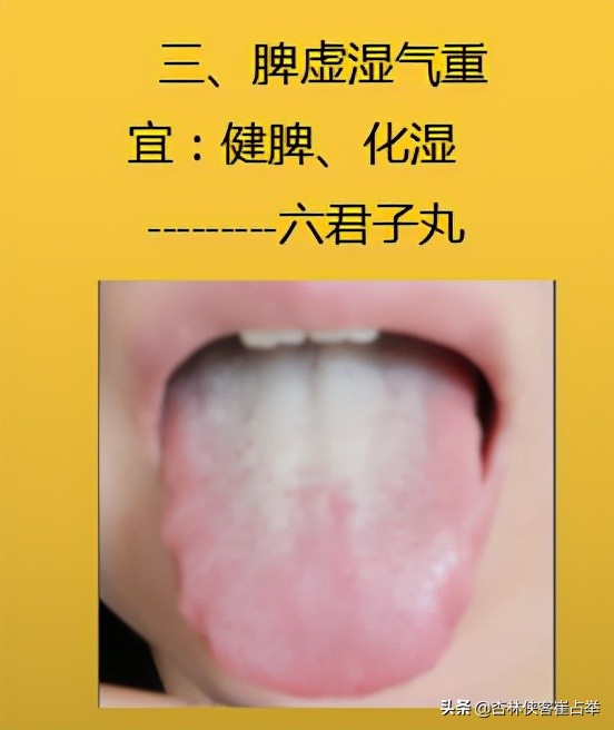 生理性齿痕舌与病理性齿痕舌,齿痕舌形成的原因是脾虚还是瘀血