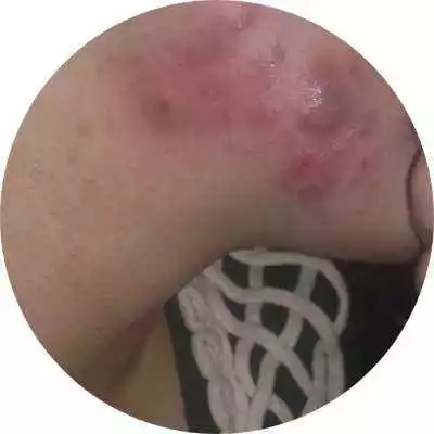 痘痘的相关问题,关于痘痘小常识