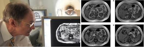 糖尿病消耗的是脂肪还是肌肉,糖尿病如何调养肝脏和胰腺