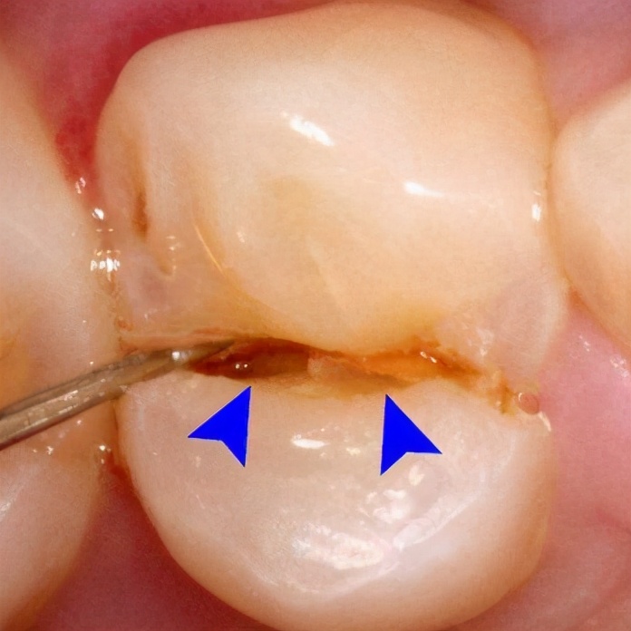 根管治疗做冠的牙齿会裂开吗,根管治疗后牙齿裂了还能做外冠吗