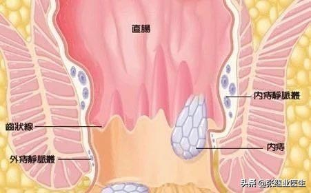 小痔疮大隐患,小痔疮用啥药