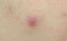 脸上痘痘一直反反复复怎么回事,脸上痘痘一直反复长痘印消不下去