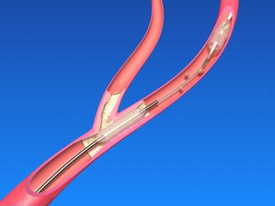 深静脉血栓介入治疗最新专家共识,静脉窦血栓介入手术咋做