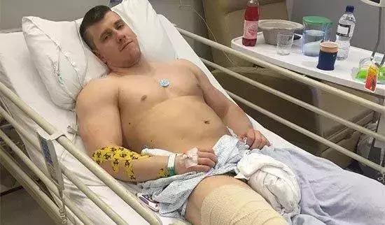 26岁健美冠军小腿静脉爆裂,22岁小伙健身过猛导致内脏撕裂