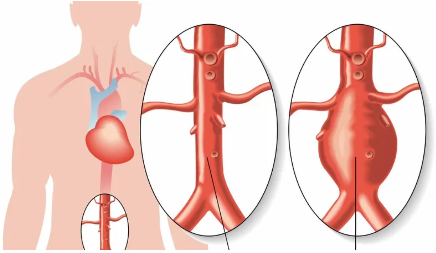 吸烟为什么引起腹主动脉瘤,吸烟对动脉瘤的影响