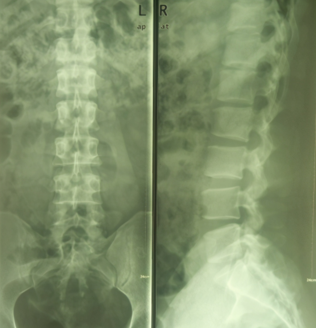 50岁男人腰背疼是怎么回事,受凉引起腰背肌筋膜炎