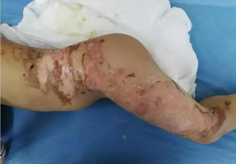 苏州科技城医院烧伤整形科｜谨防烧烫伤，变成一个更美好的你