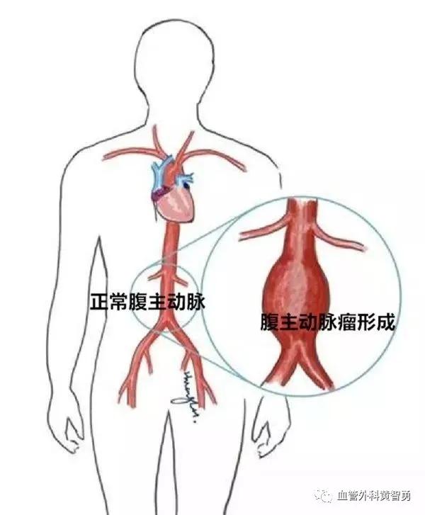 医生揭秘腹主动脉瘤形成的原因,腹主动脉瘤怎么治疗效果最好