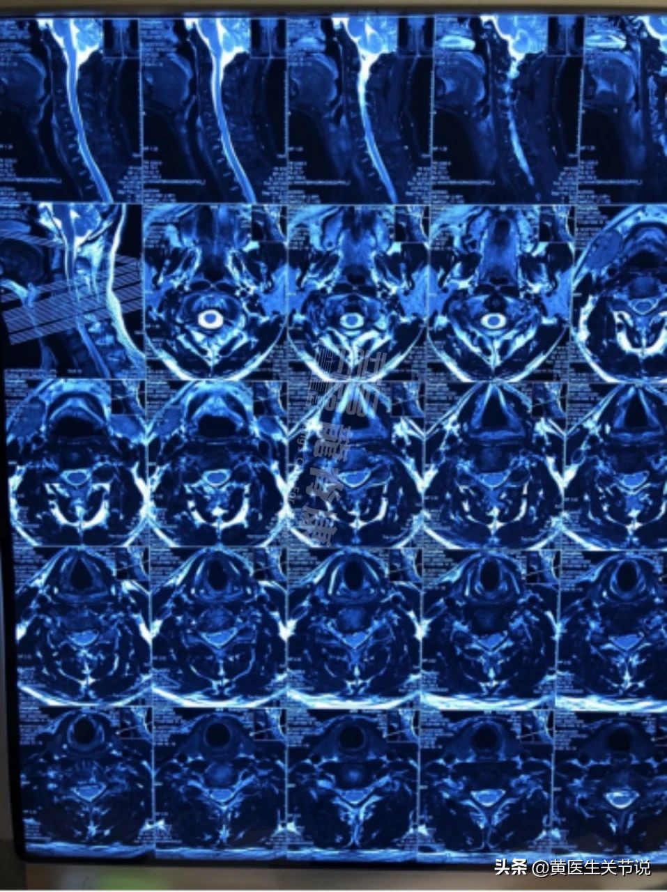 颈椎间盘突出不手术能恢复原位吗,颈椎间盘突出椎管狭窄必须手术吗