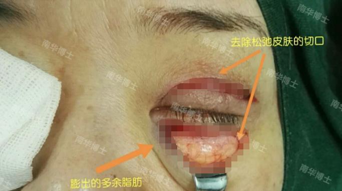 眼袋去除脂肪手术的3d演示,眼袋手术怎样快速消除淤血