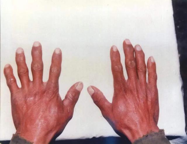 大骨节病科普视频,关于膝盖痛你了解多少