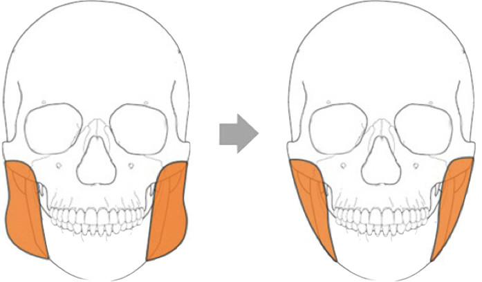每日一肌大臂疼,牙疼咬肌肿了