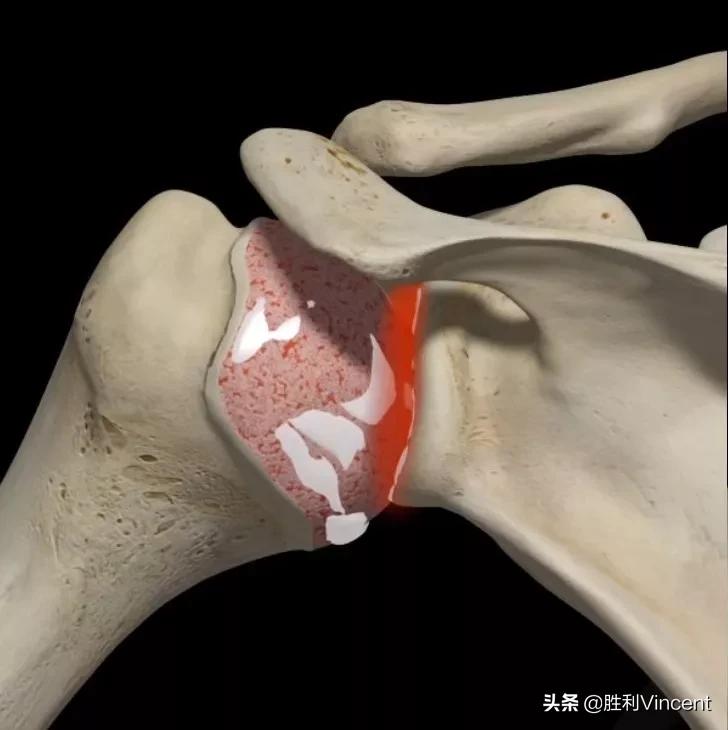 踝关节易扭伤的解剖学基础是什么,常见踝关节运动损伤的类型和原因