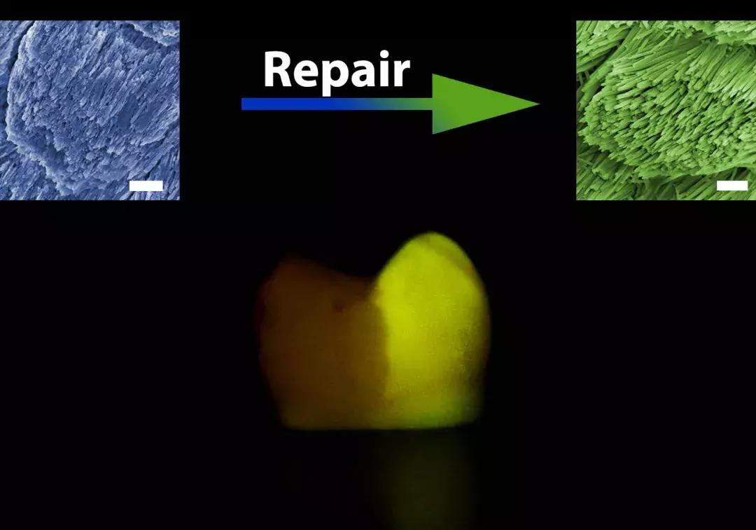 牙齿牙釉质缺损的修复方式,牙齿缺损自己修复