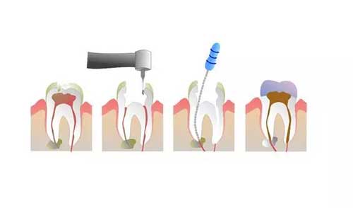 根管治疗后可以只打桩不做冠吗,根管治疗加烤瓷冠修复能用多少年