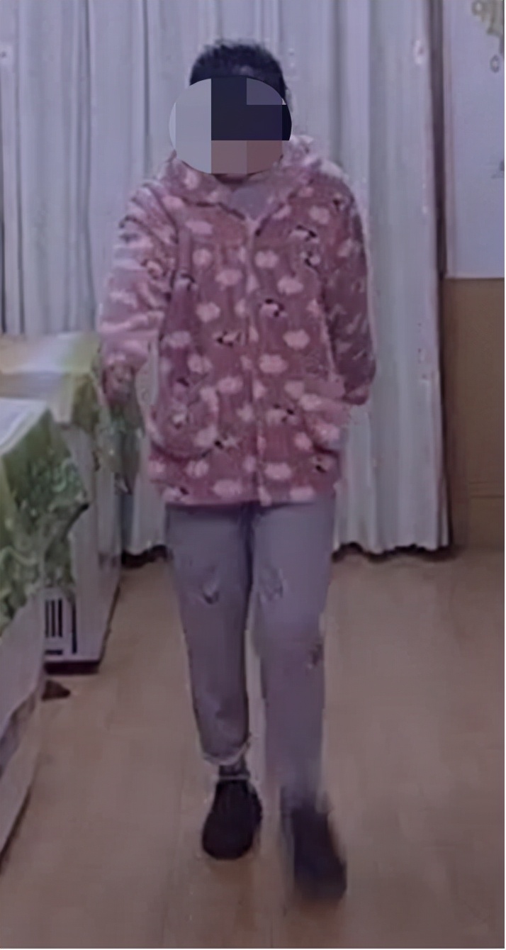 AI助力精准处理IV型髋关节发育不良花季少女翻开人生新篇章