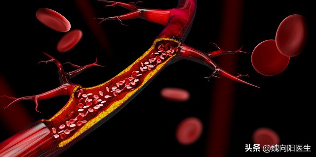 年纪轻轻得脑梗是什么原因,年纪轻轻就脑梗