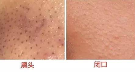 去黑头粉刺比较有效的方法,去黑头粉刺的最简单方法