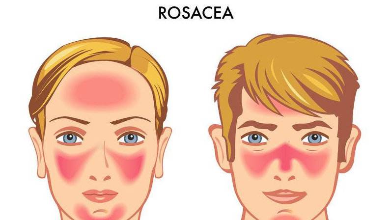 玫瑰痤疮脸发红用什么护肤品,玫瑰痤疮红肿痒怎么办