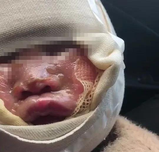 七个月的宝宝大面积烫伤警察帮助,小孩被火锅烫伤后怎么处理