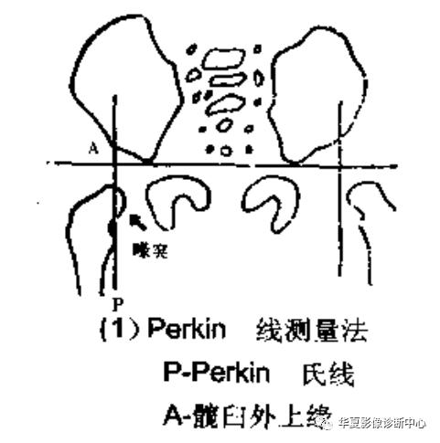 先天性髋关节脱位饮食,先天性髋关节脱位属不属于残疾人