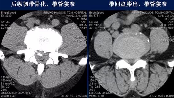 腰突压迫神经导致脚疼怎么办,脚痛无法形容的痛
