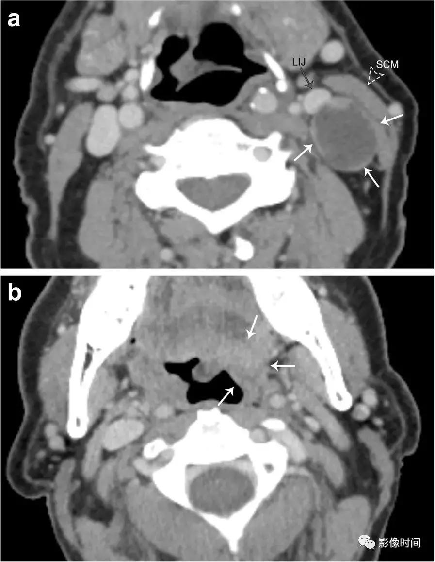 双侧颈动脉鞘间隙多发小淋巴结影,双侧颈动脉间隙多软组织密度结节