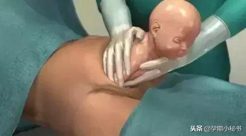 顺产生孩子剖腹产的真实流程,顺产剖腹产生孩子的真实流程