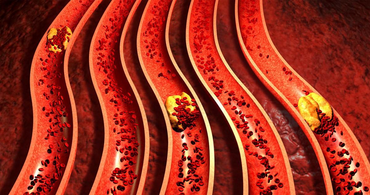 中风反复复发怎么办,中风复发的最佳方法