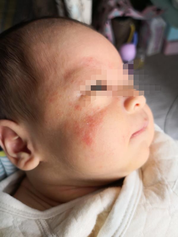 湿疹和接触性皮炎的用药,跟湿疹战斗的日子