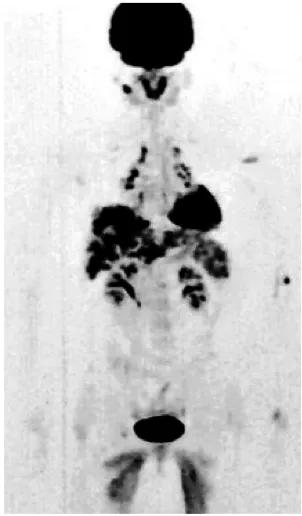 肺结节加重有什么明显症状,肺结节消失是什么原因
