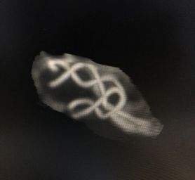 Tubridge®治疗多发性动脉瘤