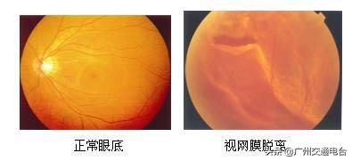 爱尔眼科能做视网膜脱落手术,爱尔眼科手术后视网膜脱离