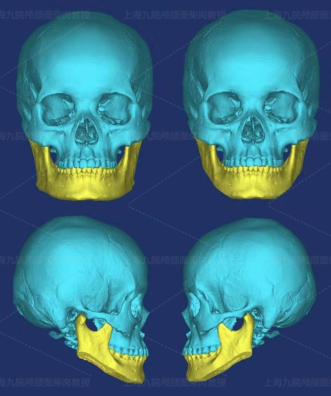 颧骨和下颌角有没有必要一起做,颧骨高割下颌角会老得快吗