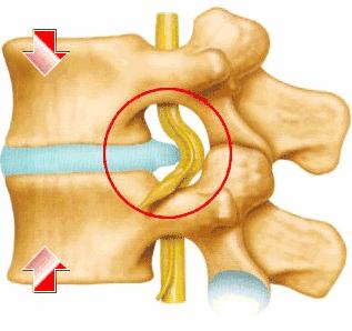 腰椎突出腿麻腰痛该如何治疗,腰椎弯曲腰疼腿疼怎么治疗