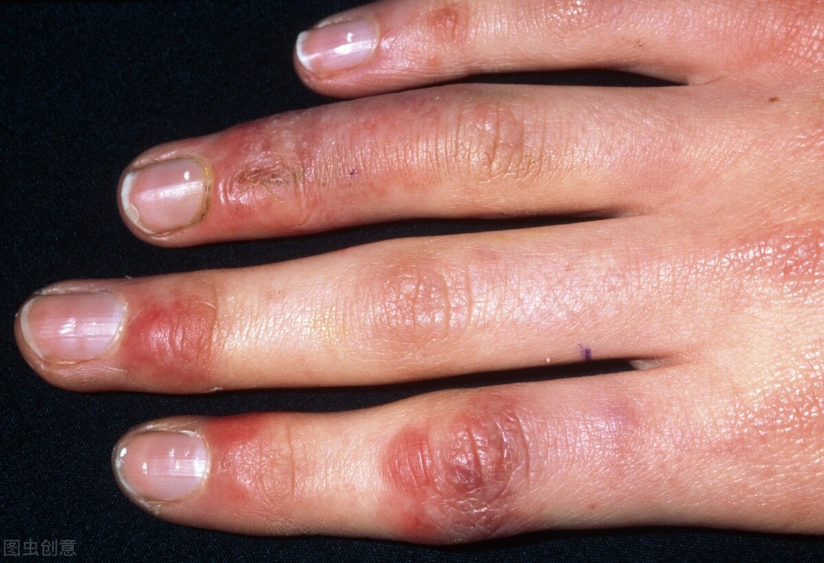 手冻僵后怎么处理才不会生冻疮,手冻僵了用热水洗会冻疮吗