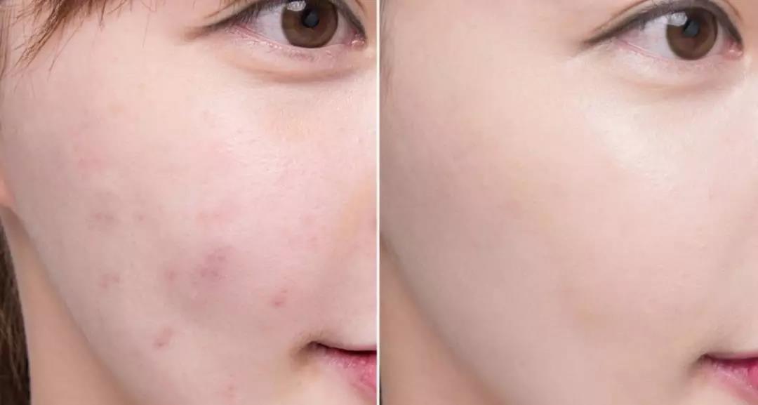 适合夏天油皮痘肌的水乳测评,fresh水乳适合敏感肌油皮