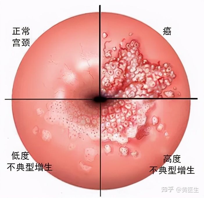 十个问题：让你三分钟了解HPV