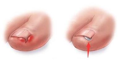 脚趾根部肿痛化脓怎么回事,脚趾发炎化脓了在家怎么处理