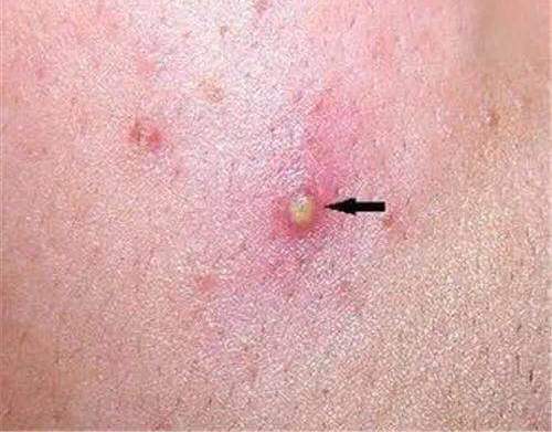 痘痘怎么挤才是正确的视频,痘痘怎么挤闭口