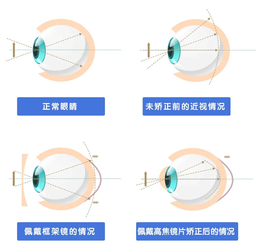 为治好近视，TA把眼睛搞瞎了